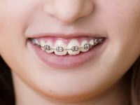 Braces